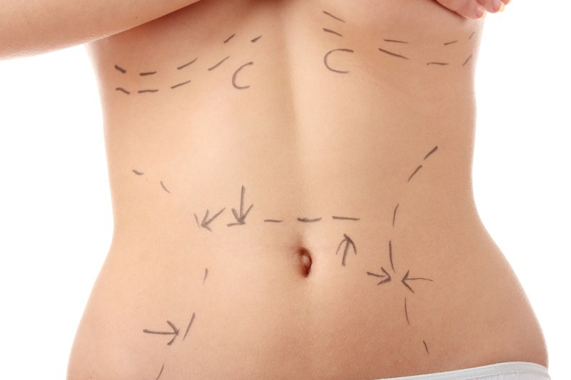 Caucasian woman's abdomen marked with lines BodyTite and FaceTite