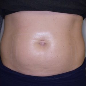 Cellulite Reduction Before Profound Before