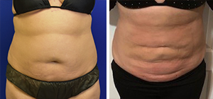 Lipo, Body Tite from the front