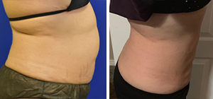 Lipo, Body Tite from the side