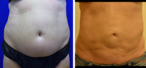 Liposuction, Bodytite
