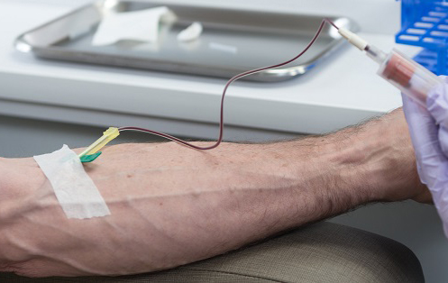 Platelet Rich Plasma Collection PRP Collection