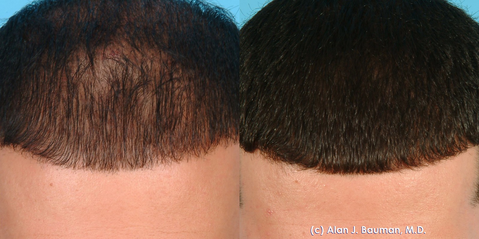 PRP Injection Therapy Hair Loss Example PRP Hair Loss Example