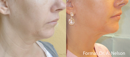 Double Chin Treatment Before After