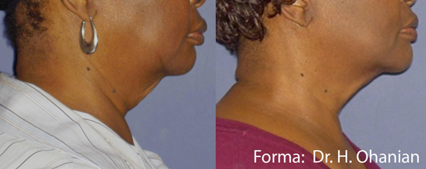 Before After Double Chin Find A Better You