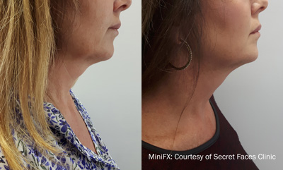 Before and After Double Chin Treatment