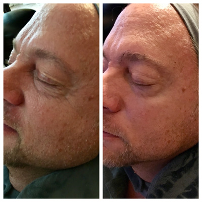 Men's Facial Men's Med Spa Facial