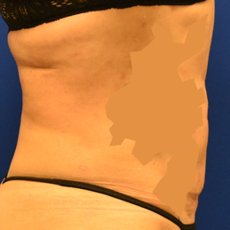 Liposuction Liposuction After