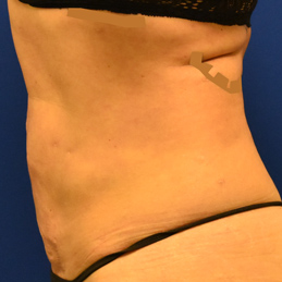 Liposuction Liposuction After