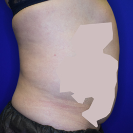 Liposuction Liposuction Before