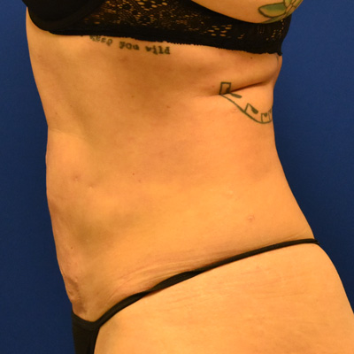 Liposuction-after-1 Liposuction After 1