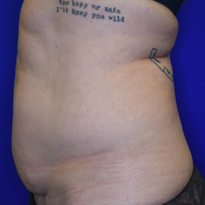 Liposuction-before-1 Liposuction Before 1