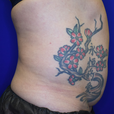Liposuction-before-2 Liposuction Before 2
