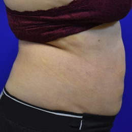Lipo-after-1week-right-B Liposuction 1 Week After Right Side