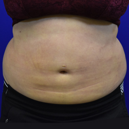 Liposuction-after-1week-front-B Liposuction 1 Week After Front