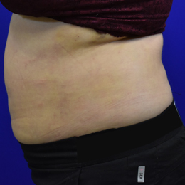 Liposuction-after-qweek-left-B Liposuction 1 Week After Left Side