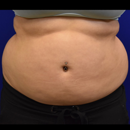 Liposuction-before-front-B Liposuction Before Front