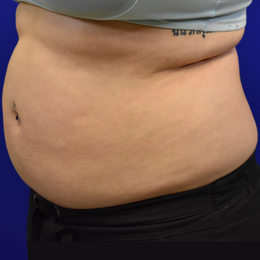 Liposuction-before-left-B Liposuction Before Left Side