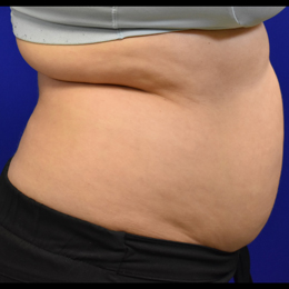 Liposuction-before-right-B Liposuction Before Right Side