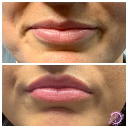Botox Lip Flip - Upper Lip Before and After