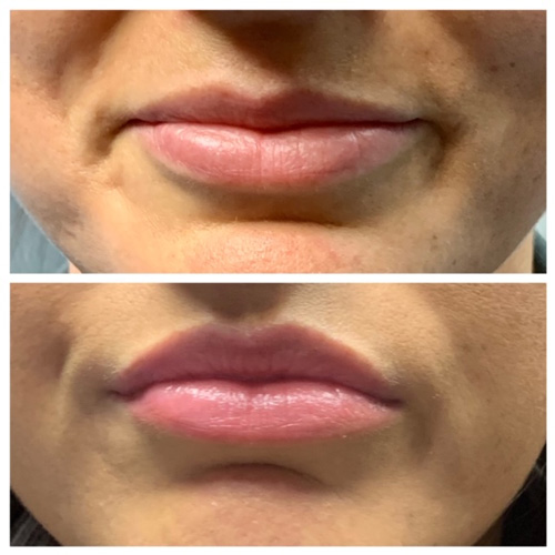 Botox Lip Flip - Upper Lip Before and After Results