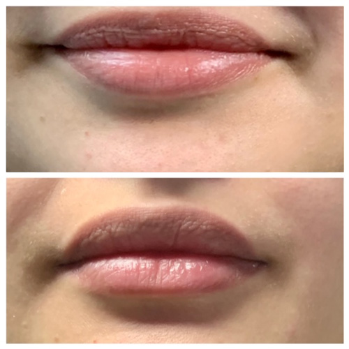 Botox Lip Flip - Lower Lip Before and After