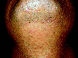 Laser Hair Removal - After