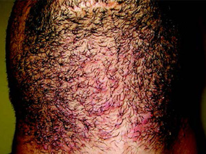 Laser Hair Removal - Before