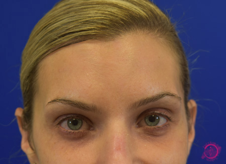 Cosmetic Injectables After - Newtox After