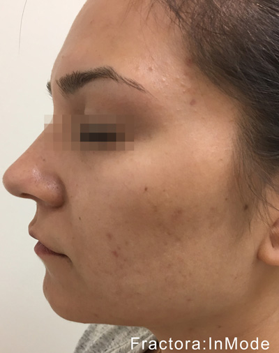 Fractora Skin Resurfacing Before and After