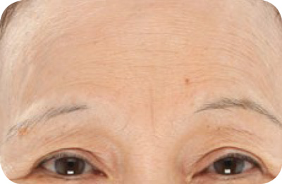 LightStim LED - Wrinkles & Anti-Aging Light Before 1