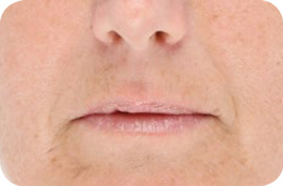 Wrinkles (Anti-Aging) Before - LED Light Therapy