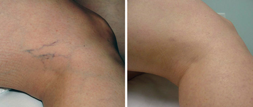 Leg Veins Removal Before and After - GentleMax Pro