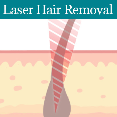 Laser Hair Removal St Peters
