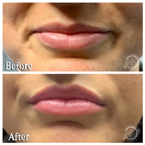 Botox Lip Flip - Upper Lips