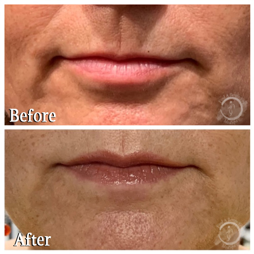 Botox Lip Flip - Upper Lip 2