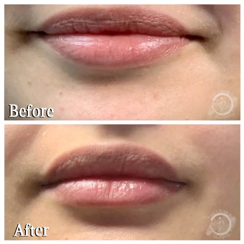 Botox Upper Lip - Lower Lip