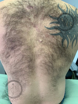 Laser Hair Removal Before - Back