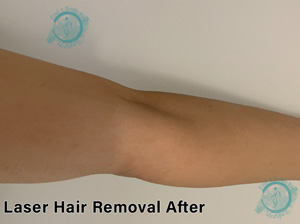 Laser Hair Removal Arms After