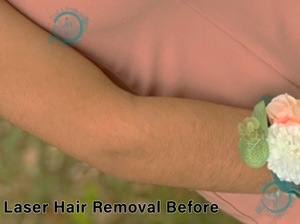Laser Hair Removal Arms Before