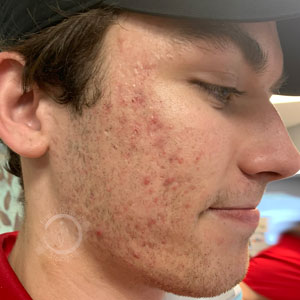 Microneedling Before (Acne Scars) - Right