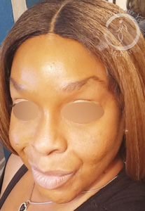 Microneedling Face Before