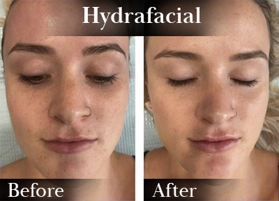 Hydrafacial Face Before & After