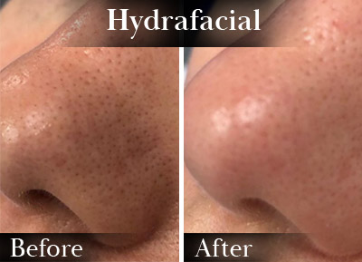 Hydrafacial Nose Before & After