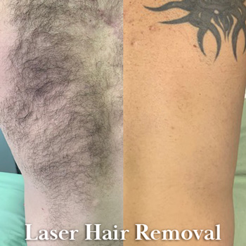 Laser Hair Removal Before and After Back