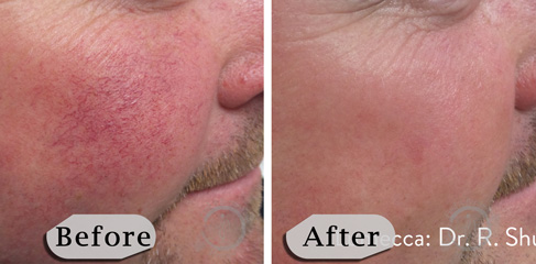 Lumecca IPL Photofacial B&A