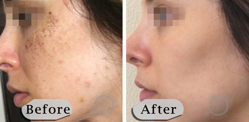 Lumecca IPL Photofacial B&A