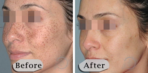 Lumecca IPL Photofacial B&A