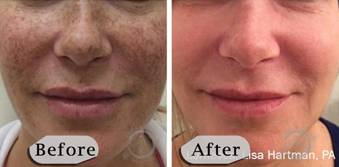 Lumecca IPL Photofacial B&A