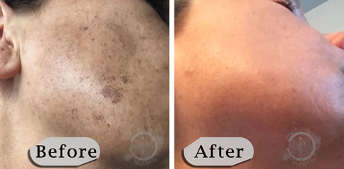 Lumecca IPL Photofacial B&A